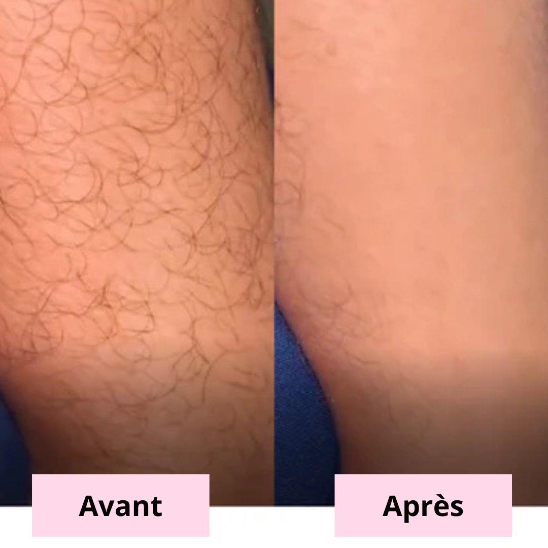 Tondeuse Bikini - Édition Limitée ☀️